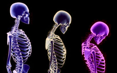Osteoporosis